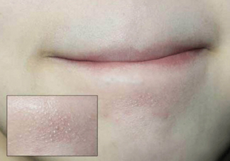 抿嘴時(shí)下巴上面的白色小顆粒是不是粉刺