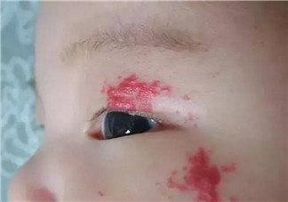 寶寶胎記多大治療最好 寶寶治療胎記的最佳時間