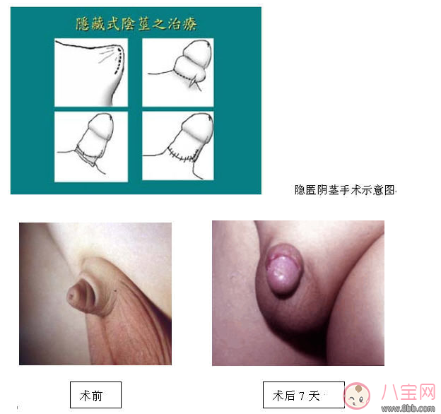 嬰兒陰莖短小 男寶寶下面很小是正常的嗎