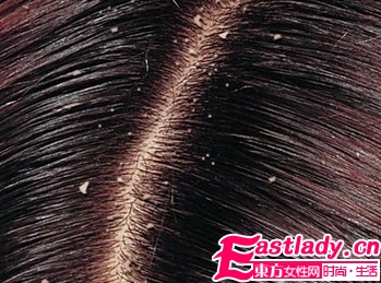 秋冬季節(jié)如何避免頭皮屑